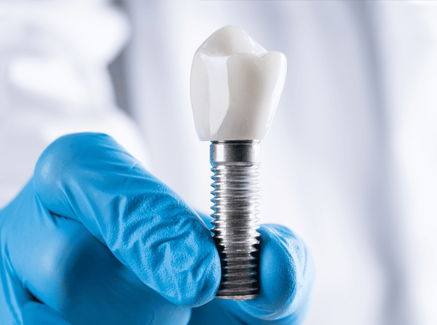 DENTAL IMPLANTS