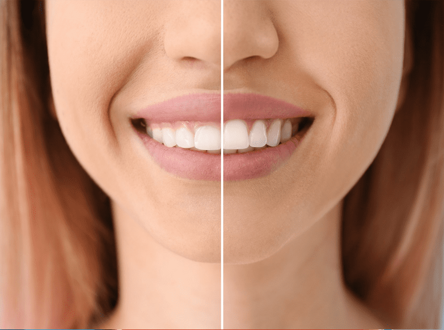 GUMS CONTOURING